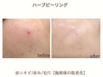 ミリ(MiLi)/ハーブピーリング