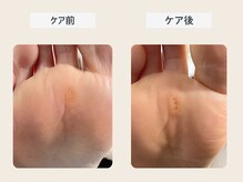 ルポ 伊勢/ウオノメのケア