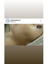 サロンエム(Salon m)/ニキビケア