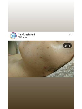 サロンエム(Salon m)/ニキビケア