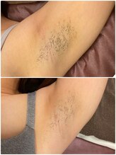 アネル 浦添店(anel)/ワキ脱毛でツルツル美肌へ！