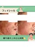 ◆フェイシャル◆【本気の肌質改善】ニキビケア専門¥16,500→¥15,400