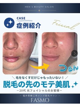 ファスモ(FASMO)/光フェイシャル