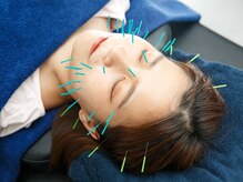 ハリハリ(HALIHALI)/美容鍼灸☆