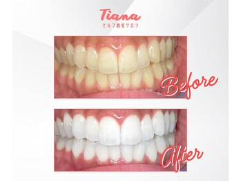ティアナ 高知店(Tiana)/ホワイトニング　Before&After