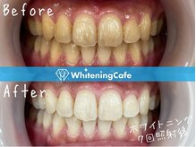 ホワイトニングカフェ 豊中店(WhiteningCafe)/◎歯のホワイトニング施術写真◎