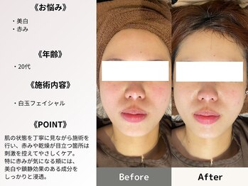 ルディラ 上野店/白玉フェイシャル