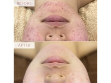 ディシエル(D'ciel)の雰囲気(20代ストレスによる慢性ニキビ改善)