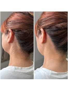 リモレア(RemoLe'a)/うなじ WAX＋光の[MIX脱毛]