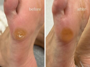 爪のいろは/フットケア　足裏　角質ケア