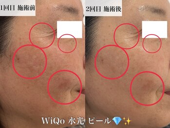 ウィ アネラ(U'i Anela)/WiQo 水光ピール