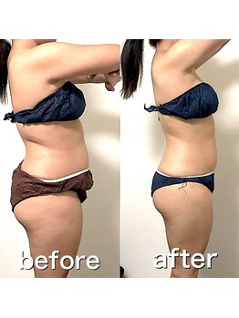 エステサロンクオーツ/ラジオ波＆筋膜リリース