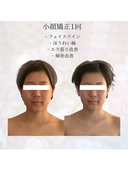ビスイ 恵比寿(Bisui)/恵比寿/小顔矯正/コルギ/施術1回