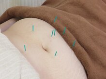 マック鍼灸院(MAC鍼灸院)/お腹周りが気になる方に