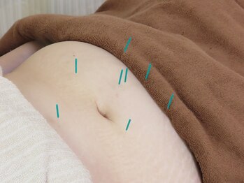 マック鍼灸院(MAC鍼灸院)/お腹周りが気になる方に