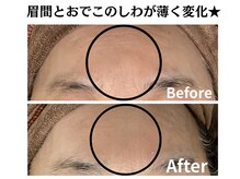 グレースティー 森町 箕面/眉間とおでこのしわが薄く★
