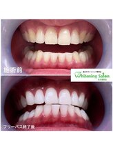 ホワイトニングサロン 名古屋駅店/【ホワイトニング施術例】