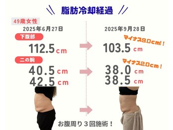 ココ(Coco)/脂肪冷却／痩身