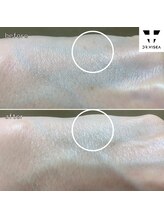 ルミラポー(Lumira Peau)/40代2回