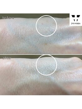 ルミラポー(Lumira Peau)/40代2回