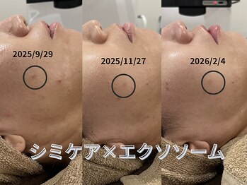 テセラ(Tethere)/シミケア