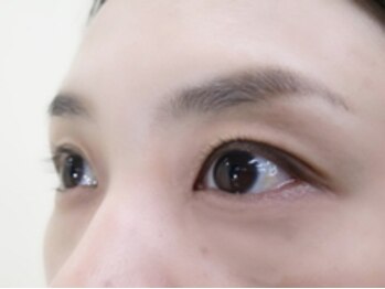 アビオ 戸田店(ABIO)/施術前★before