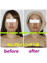 ボディグロス 梅田店(BODY GLOSS)/セレブエイジング &nbsp;1回　