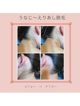 ノノ(nono)/うなじ～えりあし脱毛