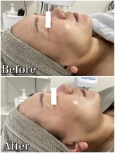 ホリシア 博多(HORISHIA)/ハーブピーリング/ニキビケア