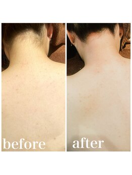 A&A 小山VAL店/うなじ＋背中WAX脱毛