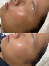 スパ ナナプラス(SPA nana+)/集中保湿◎光フェイシャル