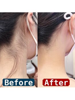 セルフ脱毛サロン SELFMADE イオンタウン仙台泉大沢店【3/29 NEW OPEN(予定)】 /【ビフォーアフター】セルフ脱毛