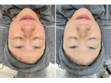 ウェイビーズ エステ(wavy's.esthetic)/【ビフォーアフター】赤味改善