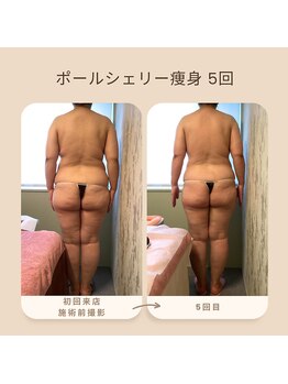 トータルサロン ヴィータ(VITA.)/ポールシェリー痩身/beforeafter