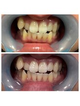 エステサロン オパール(OPALE)/セルフホワイトニング