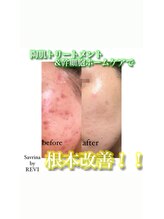 サブリナバイ ルヴィ(savrina by REVI)/10年来の繰り返し肌荒れ卒業