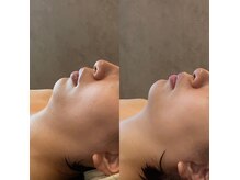 コアラル 恵比寿(COALALU)/【リフクール】ハリ小顔引き締め