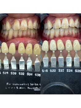 トウキョウスワーズ 池袋店(TOKYO SWRS)/#ホワイトニング #池袋 #渋谷