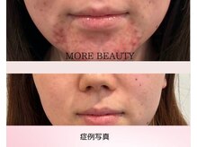 モアビューティー 庚午店(MORE BEAUTY)/症例写真
