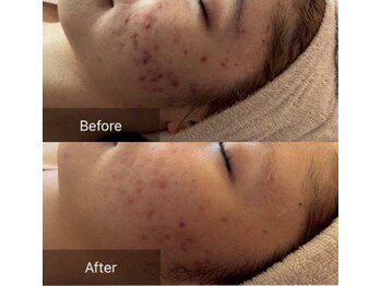 アンドエス 六本木(and S.)/プラズマ1回一ヶ月後シミの変化