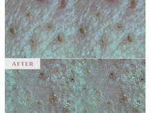 ル シャの雰囲気（マイクロスコープで確認していきます。）