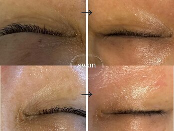 スワン 大阪南堀江(swan)/目元の小じわが気になる方