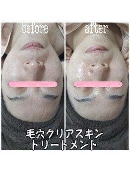 ピュルテ/毛穴クリアスキントリートメント