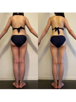 レナトゥス 銀座(Renatus)/BeforeAfter【痩身/東京/銀座】