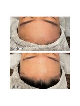 アデル 久留米(ADEL)/おでこワックス　脱毛