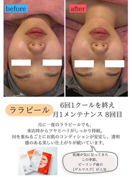 ユフラ(Juhla)/ララピール特許製品ゲルマスク