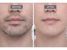 リッセ(Lisse)/ヒゲ脱毛