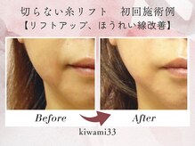 キワミ サーティスリー(kiwami33)/切らない糸リフト施術例