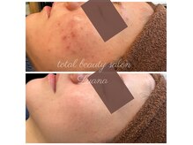 ルアナ 柏本店(LUANA)の雰囲気（長年、気になっていたニキビが綺麗に！ハーブピーリング柏）