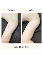 アルゴ 志免店(ALGO)/キッズ脱毛で腕、肩周りも！